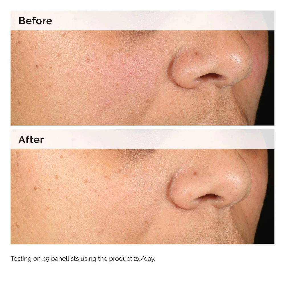 Hyaluronic Acid for Hyperpigmentation - Image 2